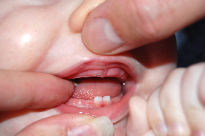 کودکی که دندان در می‌آورد